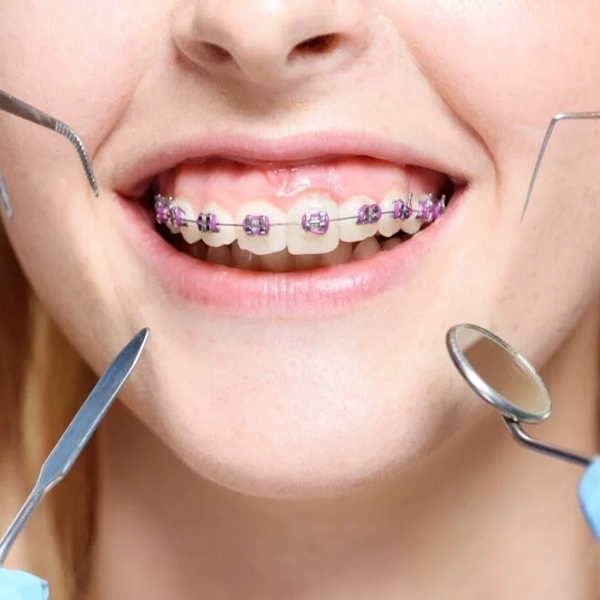 Orthodontic Treatment / Braces