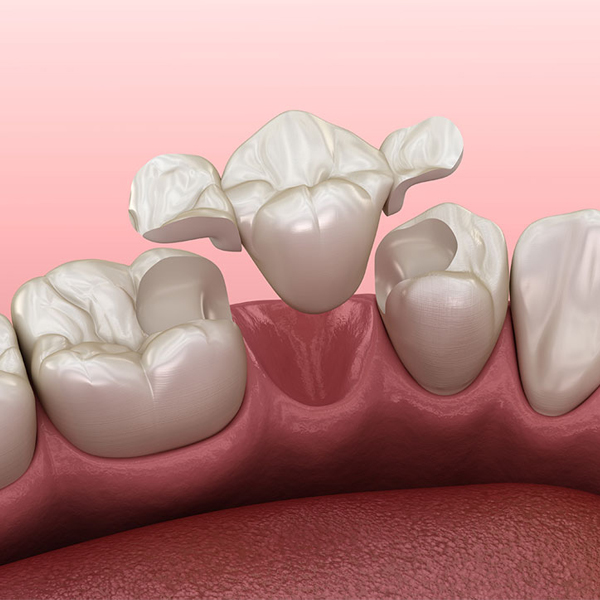 Fixed Teeth (Crown and Bridges)