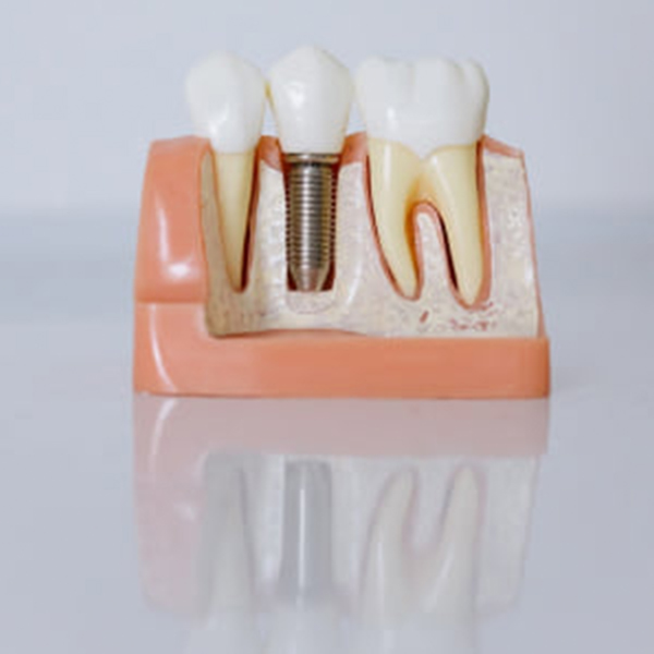 Dental Implants