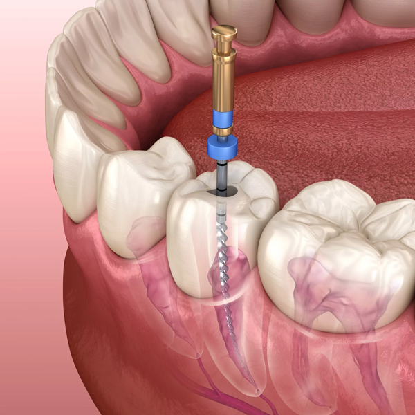 RCT(Root Canal Treatment)